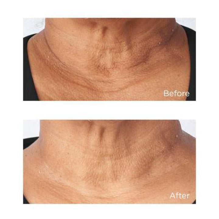 Perricone MD Cold Plasma Plus+ Eye